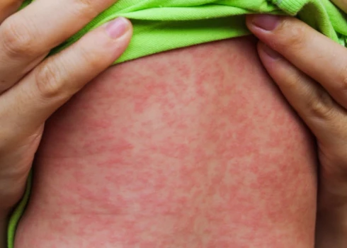 Latvijā reģistrēts pirmais masalu uzliesmojums kopš 2018. gada.