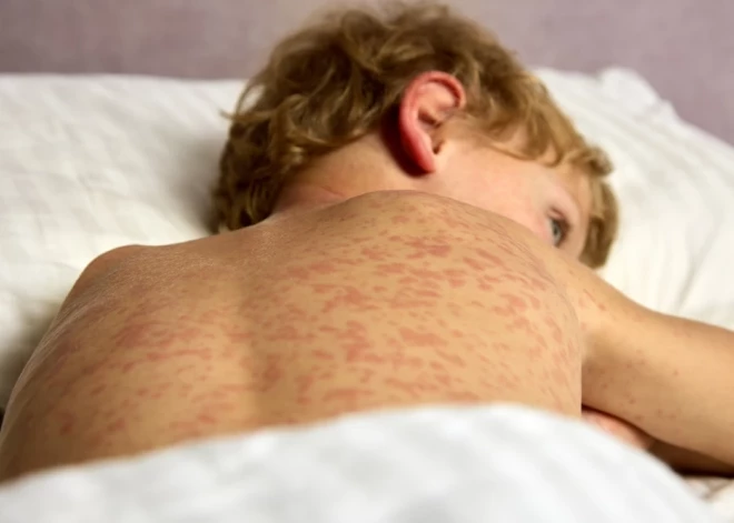 В Латвии сообщили о сотнях контактных лиц при вспышке заразного заболевания. Что важно знать уже сейчас?