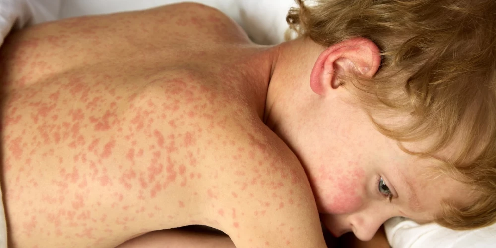 По данным Центра профилактики и контроля заболеваний, около 14 тысяч детей в Латвии в возрасте от 1 до 17 лет не получили ни одной прививки против кори.