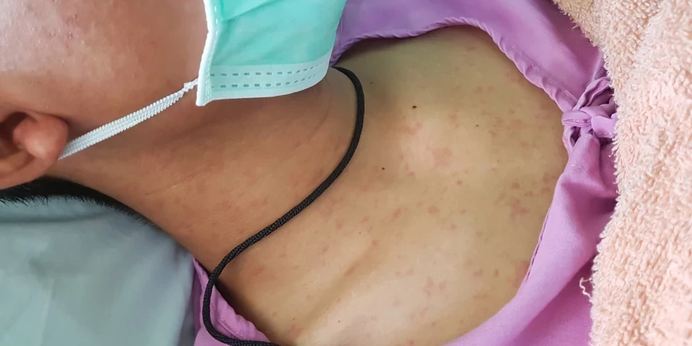 На данный момент в Латвии зарегистрированы 17 случаев кори.