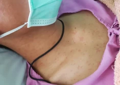 Вспышка кори в Латвия набирает обороты: уже заболели 17 человек