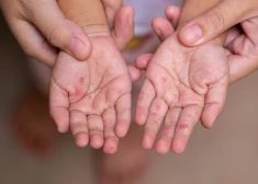 Ar vienu pasākumu un vienu nevakcinētu bērnu pietika: kā Latvijā sākās masalu uzliesmojums, par kuru brīdināja jau pirms diviem gadiem