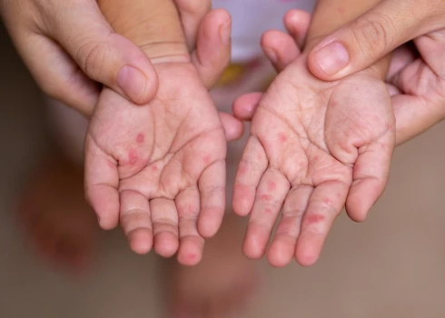 Eksperti brīdināja jau pirms diviem gadiem, bet ministrija neko nemainīja — tagad Latvijā plosās masalas.