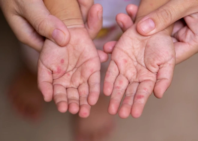 Ar vienu pasākumu un vienu nevakcinētu bērnu pietika: kā Latvijā sākās masalu uzliesmojums, par kuru brīdināja jau pirms diviem gadiem