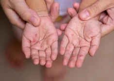 Одного мероприятия и непривитого ребенка оказалось достаточно: как в Латвии началась вспышка кори