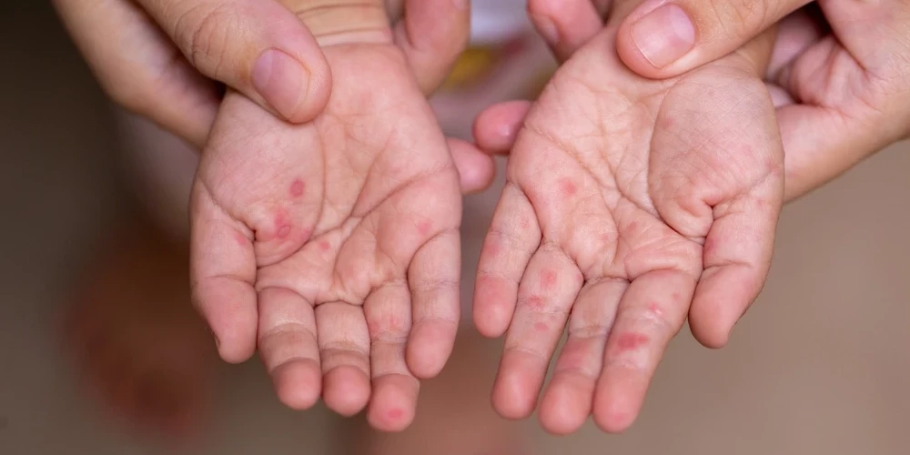 Latvijā masalu uzliesmojumā līdz šim reģistrēti 24 saslimušie.