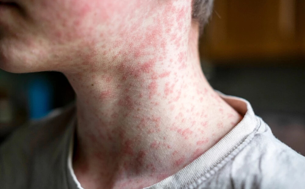 Masalu uzliesmojums Latvijā turpinās, saslimušo skaits sasniedzis 29