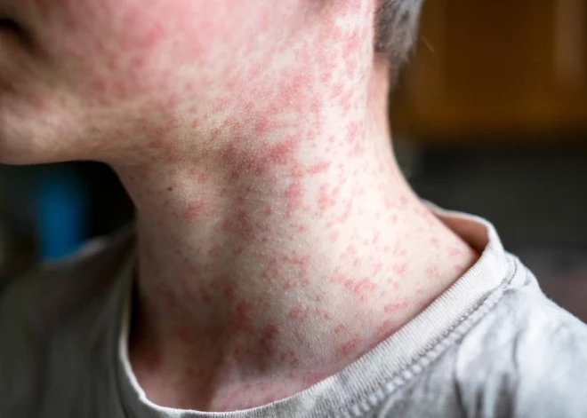 Masalu uzliesmojums Latvijā turpinās, saslimušo skaits sasniedzis 29