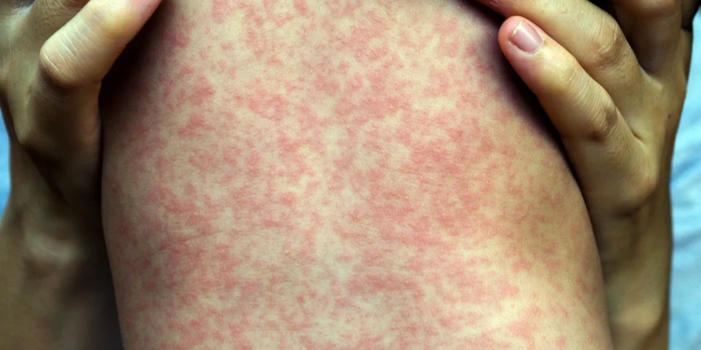 Вспышка кори в Латвии продолжается, и зарегистрировано уже 29 случаев заболевания.