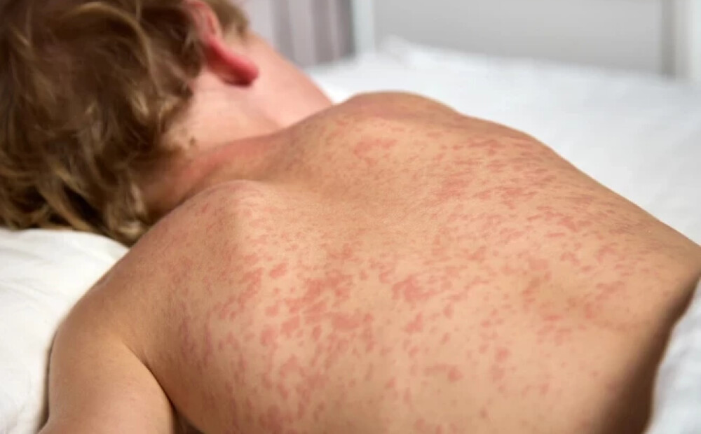 Latvijā turpinās masalu uzliesmojums - saslimuši vēl pieci cilveki, tai skaitā bērni