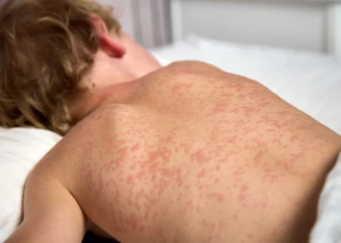 Turpina pieaugt ar masalām saslimušo skaits.