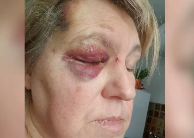 После резкого торможения трамвая рижанка получила сотрясение, ушибы и осталась один на один с последствиями.