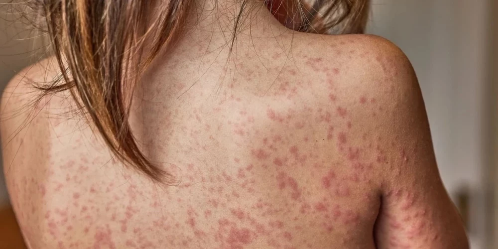 Saslimšanas gadījumi konstatēti dažādās vecuma grupās.