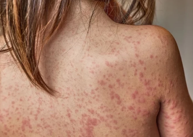 Masalas turpina izplatīties: aicina pārbaudīt bērnu vakcinācijas statusu