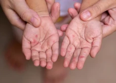 SPKC: augstā nevakcinēto īpatsvara dēļ Latvijā ir augsts masalu tālākas izplatības risks