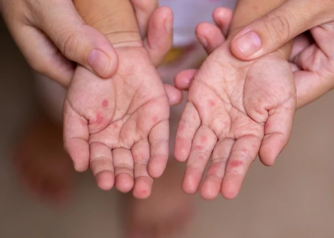 SPKC: augstā nevakcinēto īpatsvara dēļ Latvijā ir augsts masalu tālākas izplatības risks