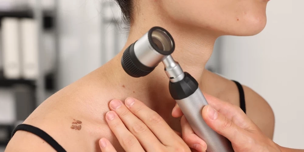 В Риге можно будет бесплатно проверить родинки и другие кожные образования без записи.