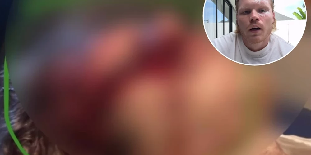 Smagā negadījumā Bali cietis latviešu fitnesa treneris Elvis Krūze.