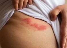 Sākas ar tirpšanu, tad parādās pūslīši un... Kas jāzina par sāpīgo slimību - jostas rozi