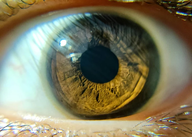 Dzīvībai bīstama vēža forma var slēpties pat jūsu acī