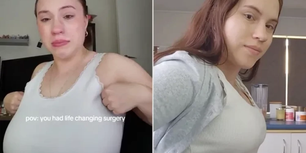 Ilustratīvs attēls. 24 gadus vecā austrāliete Eimija sociālajā tīklā “TikTok” guva plašu rezonansi pēc tam, kad dalījās ar video par krūšu samazināšanas operācijas rezultātiem — to noskatījās vairāk nekā 25 miljoni cilvēku.