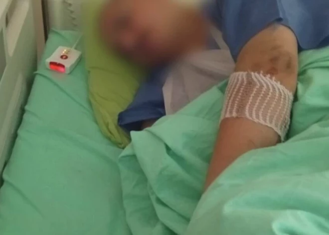 "Mums sastāstīja, ka līdz pusei roka samalta!" Jelgavas novadā gaļas mašīnā ierauta kāda vīrieša roka